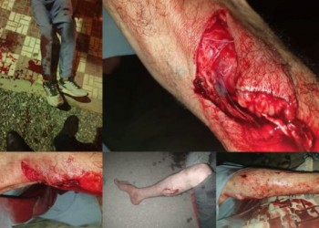 كلب يهاجم شخصين ويتسبب لهما في جروح خطيرة ببني بوعياش