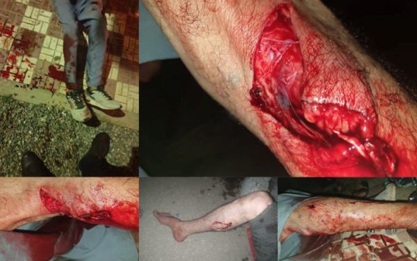 كلب يهاجم شخصين ويتسبب لهما في جروح خطيرة ببني بوعياش