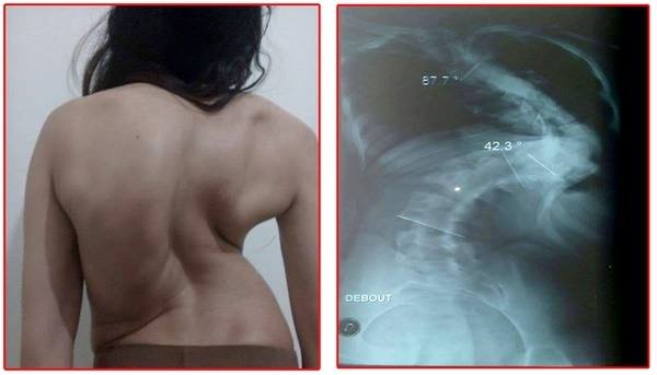 حالة مرضية لأسماء الطالبة الجامعية تكلفها مصاريف لإجراء عملية جراحية لا تقوى على تغطيتها