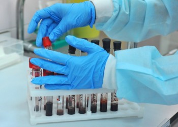 مطالبة بالسماح لمختبرات الحسيمة لإجراء تحاليل كورونا